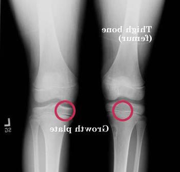 膝盖的x光片，确定生长板的位置